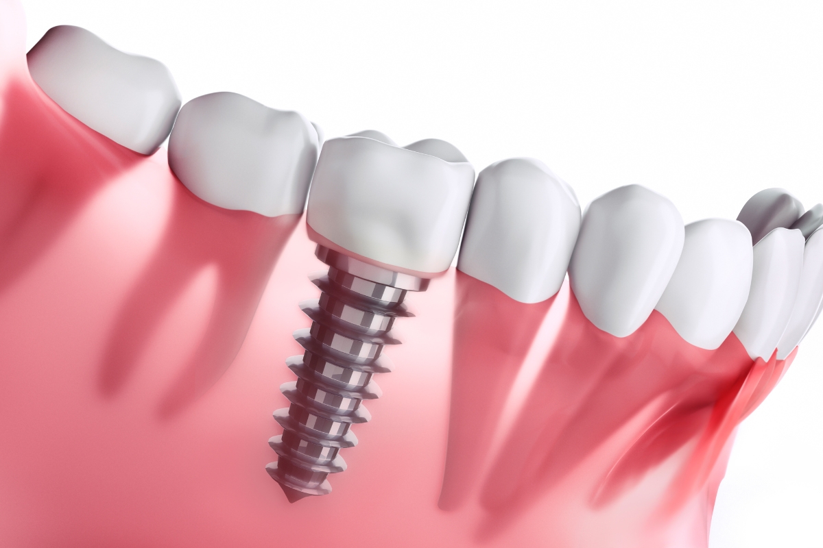 dental implants in Brookline
