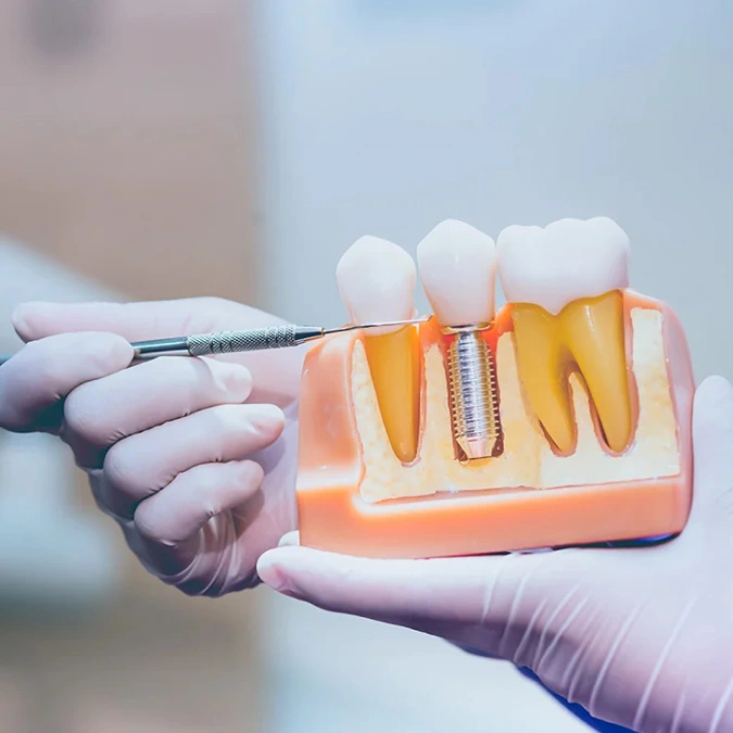 dental implants in brookline