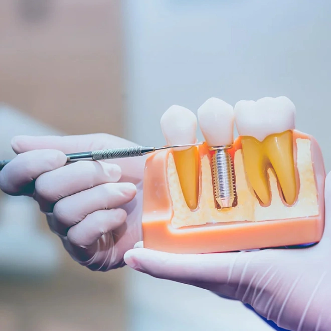 restorative dental implants brookline