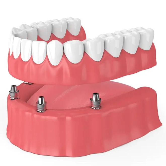 restorative implant retained dentures brookline