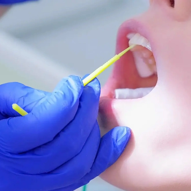 Dental Bridges in Aberdeen